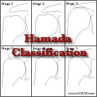 Hamada Classification Hamada Classification of RTC tear