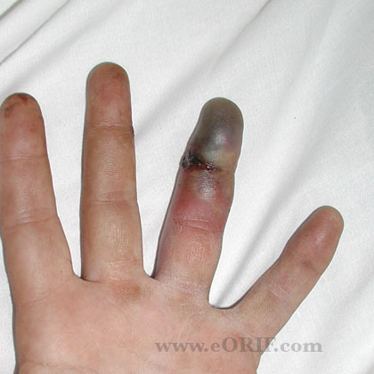 Human bite infection Human bite wound infection