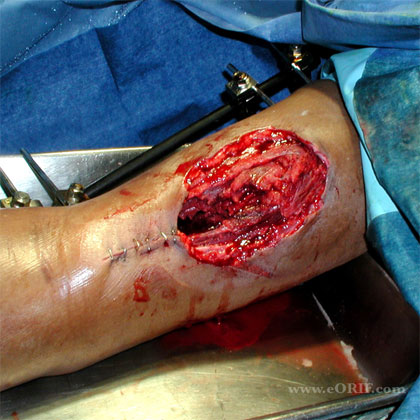 Gun shot wound Humeral Shaft external fixation GSW