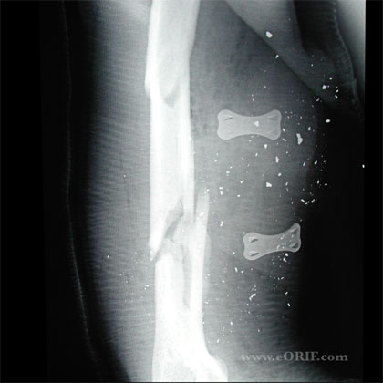 Humeral shaft fracture xray humeral shaft fracture xray