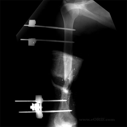 Humeral Shaft GSW xray humeral shaft external fixation A/P xray