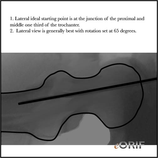Gamma nail starting point lateral view IMHS starting point
