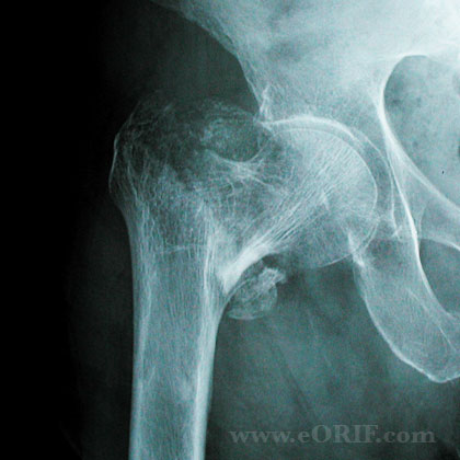 IT fracture DHS xray Intertrochanteric femur fracture DHS xray