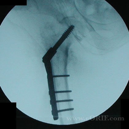 IT fracture DHS xray Intertrochanteric femur fracture DHS xray