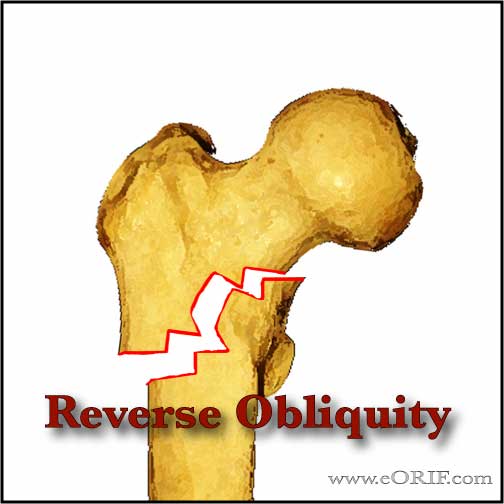 Reverse oblique intertrochanteric femur fracture image Reverse oblique intertrochanteric femur fracture image