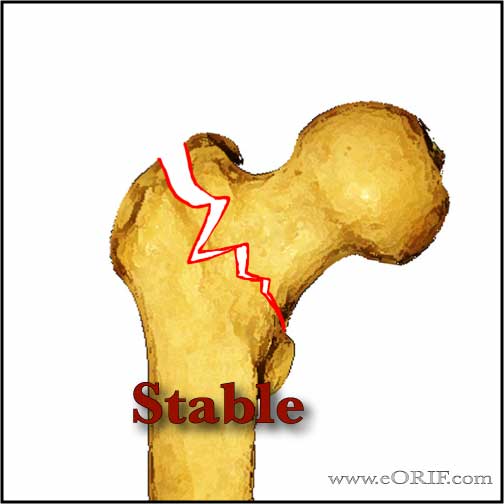 Stable intertrochanteric femur fracture Stable intertrochanteric femur fracture image