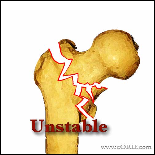 Unstable intertrochanteric femur fracture Unstable intertrochanteric femur fracture image