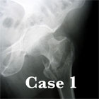 IT fracture xray intertrochanteric femur fracture xray
