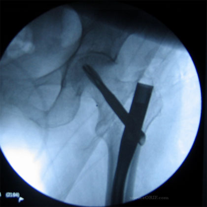 IMHS IT fracture xray IMHS intertrochanteric hip fracture xray