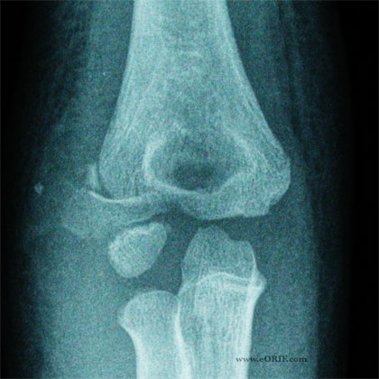Lateral Condyle Fracture xray Lateral Condyle Fracture xray