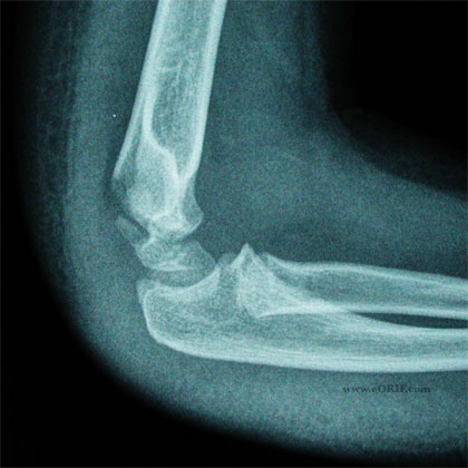 Lateral Condyle Fracture xray Lateral Condyle Fracture xray