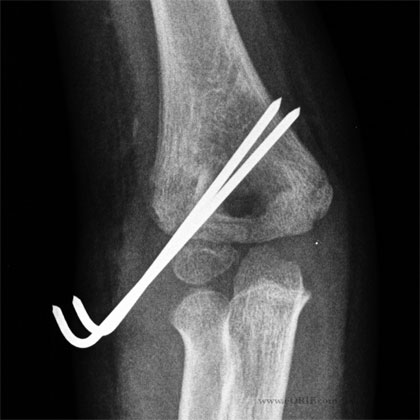 Lateral Condyle Fracture crpp Lateral Condyle Fracture crpp