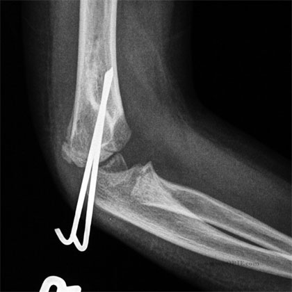 Lateral Condyle Fracture crpp Lateral Condyle Fracture crpp