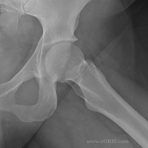 Lateral xray hip Lateral xray view of the hip