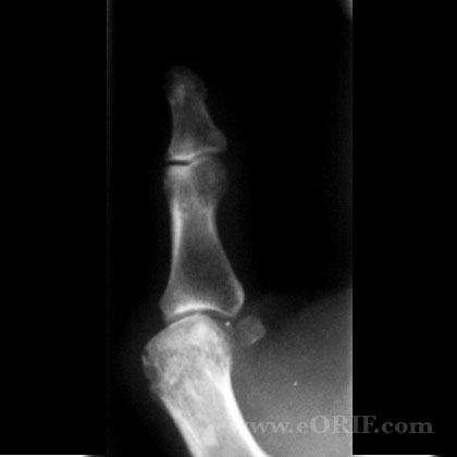 MCP osteoarthritis xray