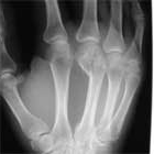 MC neck fracture xray Metacarpal neck fracture xray