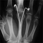 CRPP MC neck fracture xray CRPP metacarpal neck fracture xray