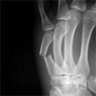 Metacarpal shaft fracture xray Metacarpal shaft fracture xray