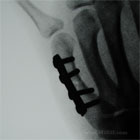 Metacarpal shaft fracture xray Metacarpal shaft fracture ORIF xray