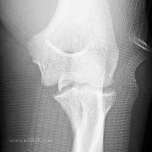 medial epicondyle fracture xray medial epicondyle fracture xray
