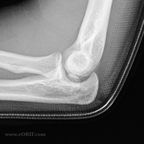 medial-epicondye-fracture-cases medial-epicondye-fracture-cases