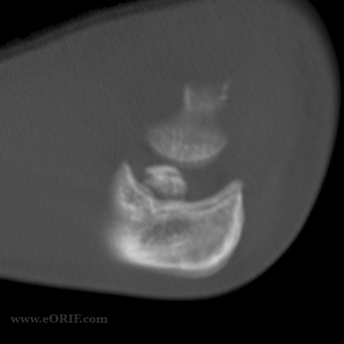 medial epicondyle fracture CT scan medial epicondyle fracture CT scan