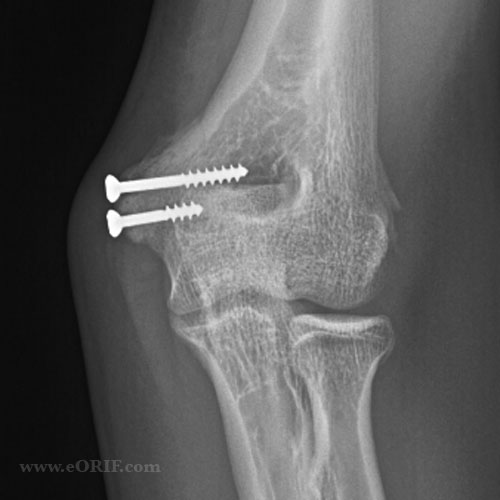 medial epicondyle fracture ORIF xray medial epicondyle fracture ORIF xray