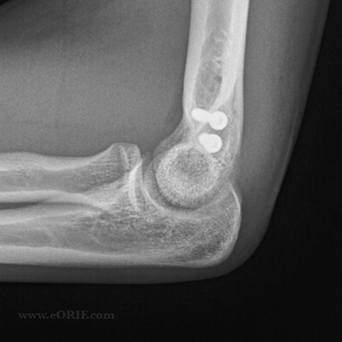 medial epicondyle fracture ORIF xray medial epicondyle fracture ORIF xray