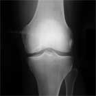 knee osteochondritis dissecans xray knee ocd xray