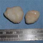 knee ocd loose bodies knee ocd loose bodies