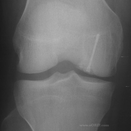 ORIF knee ocd xray ORIF knee ocd xray