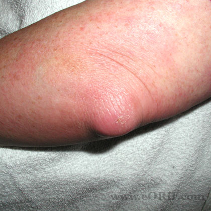 septic olecranon bursitis image septic olecranon bursitis image