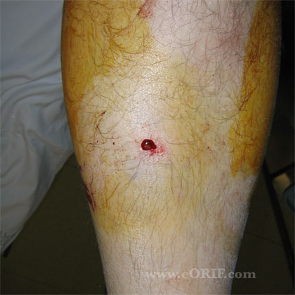 Grade I open fracture image Grade I open tibial shaft fracture image