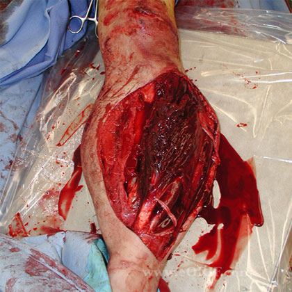 Grade IIIC open fracture imate Grade IIIC open tibial shaft fracture image