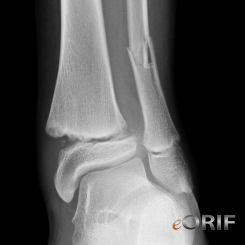 pediatric distal tibia fracture xray