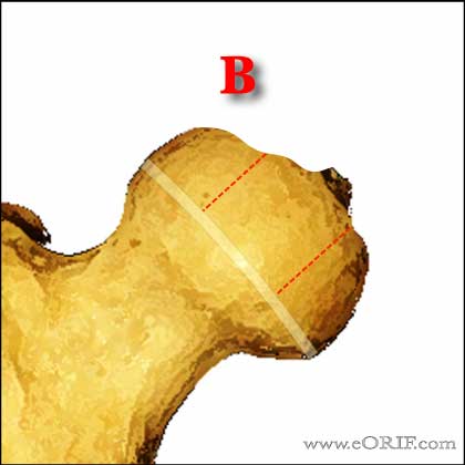 Legg-Calves-Perthes Classification