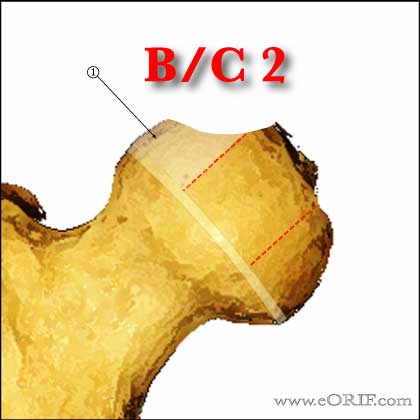 Legg-Calves-Perthes Classification BC2