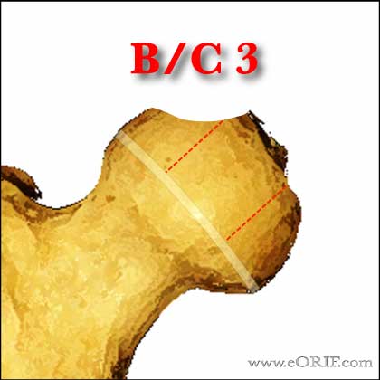 Perthes BC3
