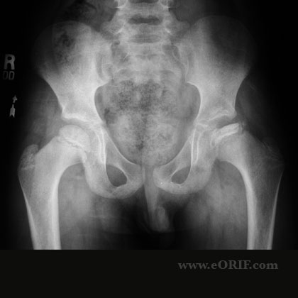 Legg-Calves-Perthes xray