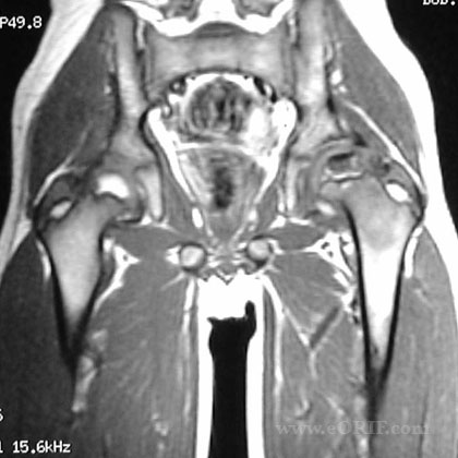 Legg-Calves-Perthes C23