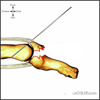 CRPP bony mallet