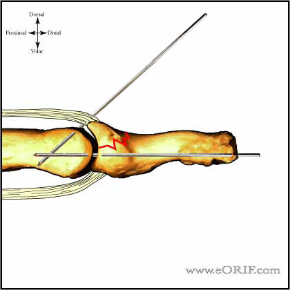 Extension Block pinning technique