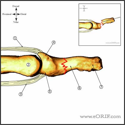 Transverse Distal Phalanx Fracture