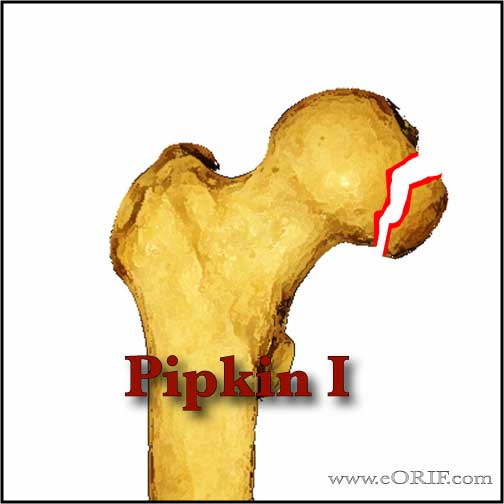 Pipkin I femoral head fracture Pipkin Type 1 femoral head fracture image