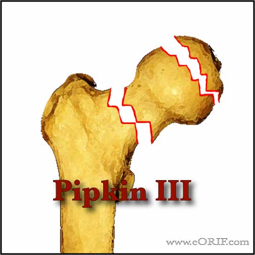 Pipkin Type III femoral head fracture Pipkin Type III femoral head fracture image