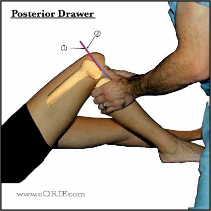 positive knee posterior drawer positive knee posterior drawer