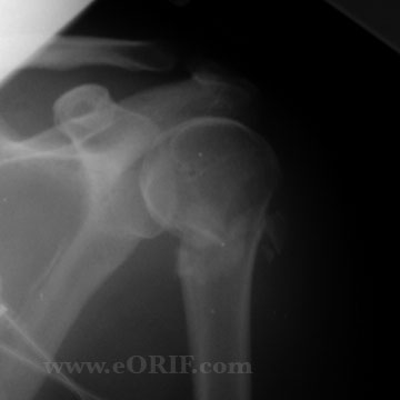 Proximal Humerus Fracture xray Proximal Humerus Fracture xray