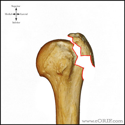 Type A1 proximal humerus fracture Type A1 proximal humerus fracture