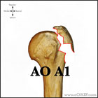 AO A1 proximal humerus fracture AO A1 proximal humerus fracture