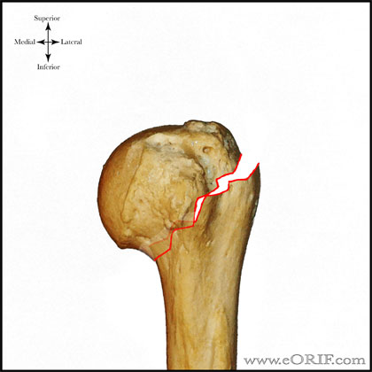 Type A2 proximal humerus fracture Type A2 proximal humerus fracture